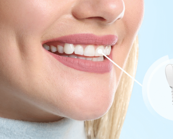 5 Reasons Dental Implants Improve Quality Of Life