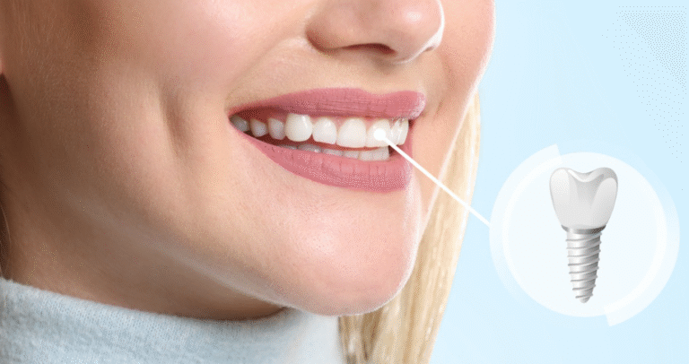 5 Reasons Dental Implants Improve Quality Of Life