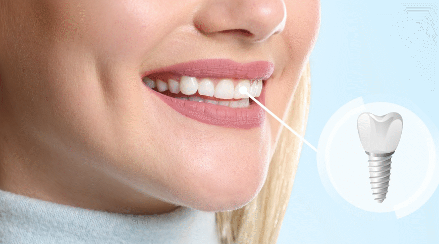 5 Reasons Dental Implants Improve Quality Of Life