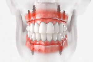 The Importance Of Surgical Precision In Implant Dentistry