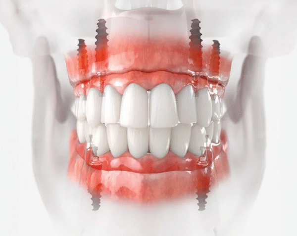 The Importance Of Surgical Precision In Implant Dentistry