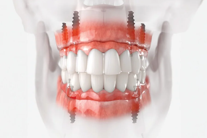 The Importance Of Surgical Precision In Implant Dentistry